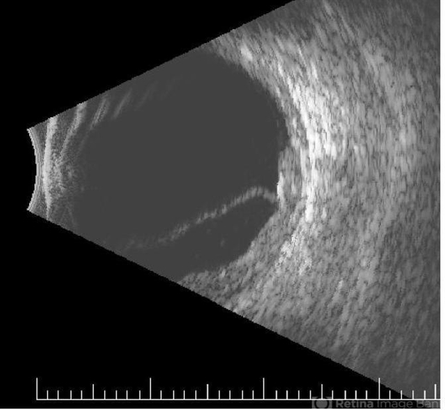 Choroidal Metastasis B-Scan - Retina Image Bank