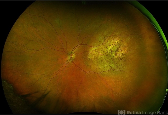 Choroidal Metastasis - Retina Image Bank