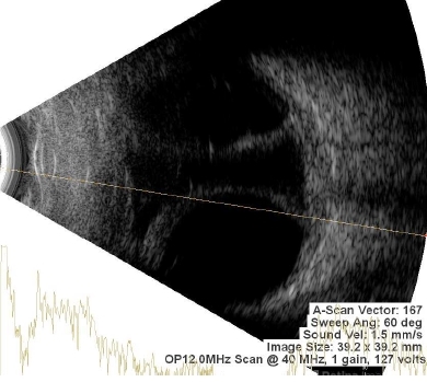 Choroidal Detachment - Retina Image Bank