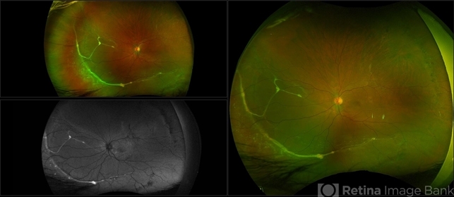 Chronic Retinal Detachment with Proliferative Vitreoretinopathy ...