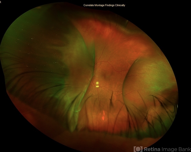 Choroidal Detachment - Retina Image Bank