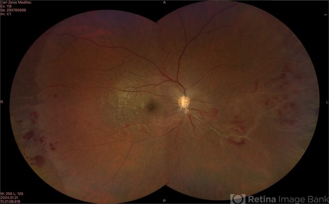 Eales Disease - Retina Image Bank