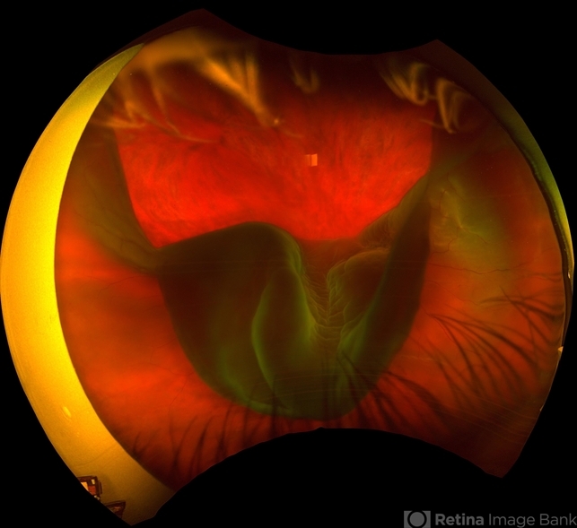 Giant Retinal Tear - Retina Image Bank