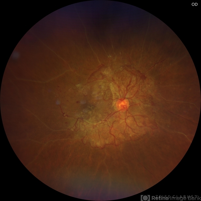 Fibrotic Vascular Tissue Proliferation - Retina Image Bank