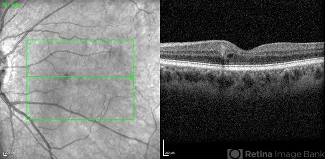 Microaneurysm With Intraretinal Fluid on Optical Coherence Tomography ...