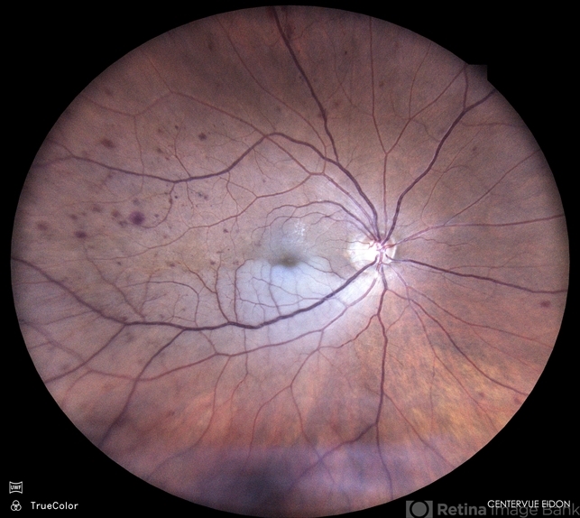 Branch Retinal Artery Occlusion - Retina Image Bank