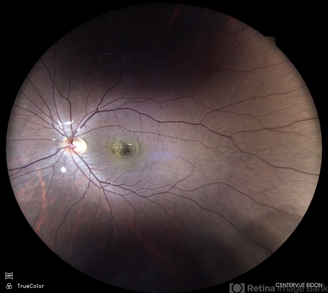 Myopic Subretinal Neovascular Membrane - Retina Image Bank