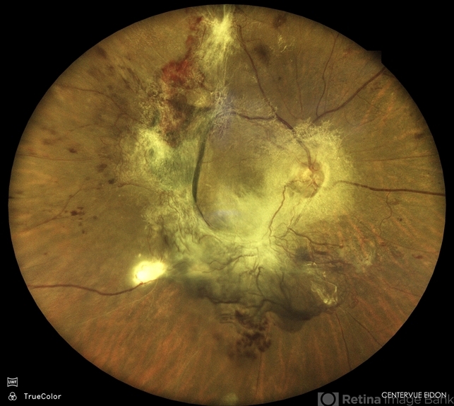 Tractional Rd Oct Table Top Tractional Retinal Detachment - Retina Image Bank