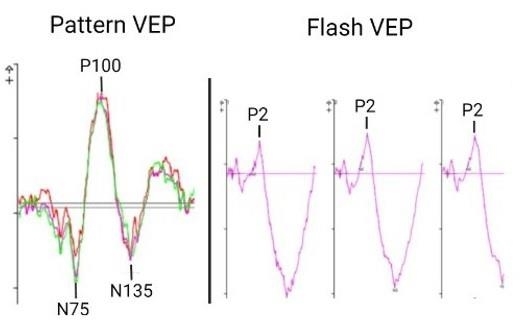 Representative Traces From Different Types of Visual Evoked Potentials ...
