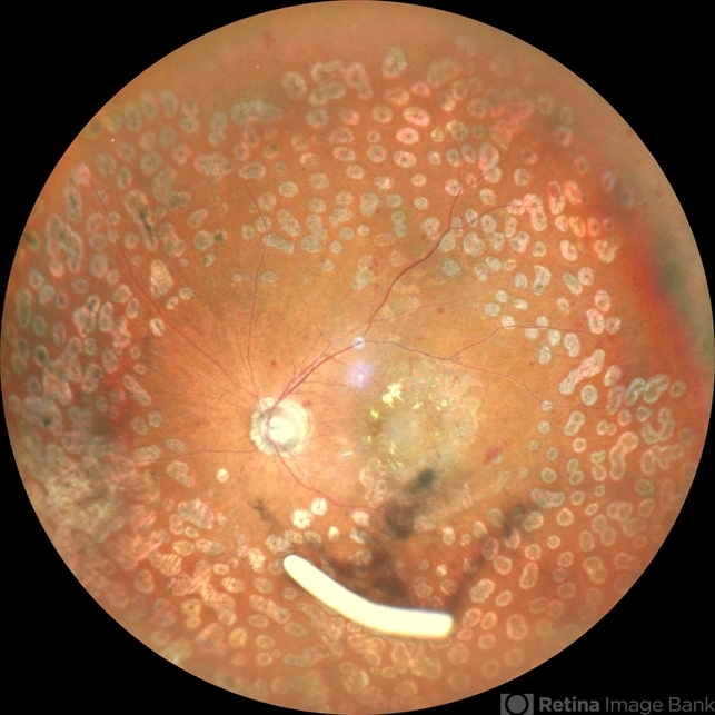Floating Ozurdex Implant Retina Image Bank