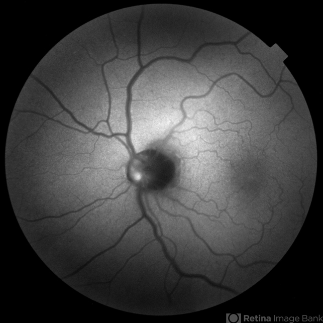 Autofluorescence in Optic Nerve Head Drusen - Retina Image Bank