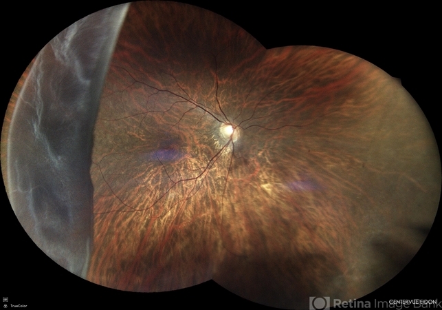 Giant Retinal Tear - Retina Image Bank