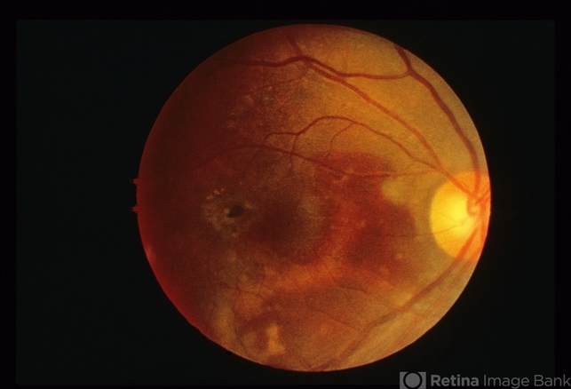 Decreases Visual Sign Central Visual Acuity Loss - Retina Image Bank