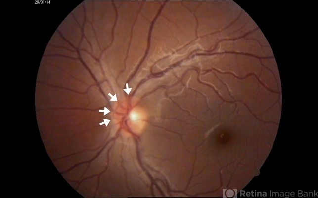 Remnant of Hyaloidal Artery - Retina Image Bank