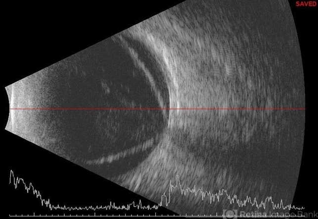 Open Funnel Retinal Detachment Retina Image Bank