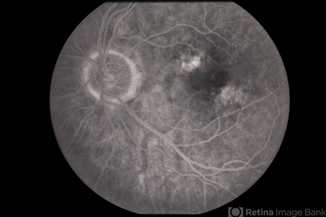 ARMD - Geographic Atrophy - Retina Image Bank