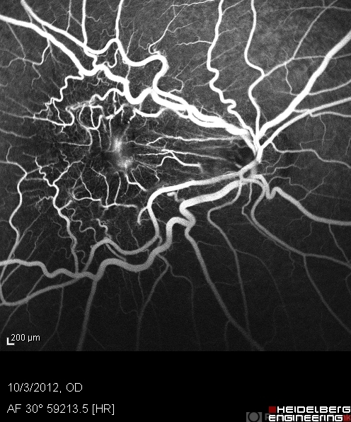 RPE Hamartoma - Retina Image Bank