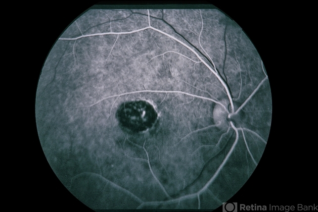 Congenital Toxoplasmosis New Lesion Retina Image Bank