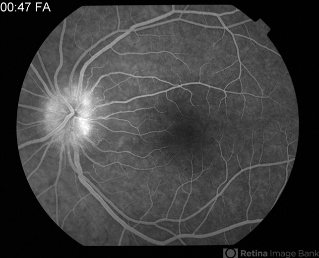 Cat Scratch Disease - Retina Image Bank