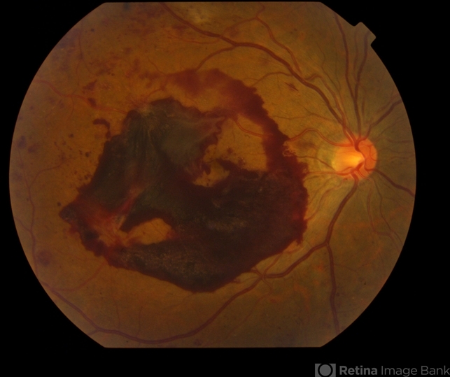 Donut-Shaped Subhyaloidal Hemorrhage - Retina Today