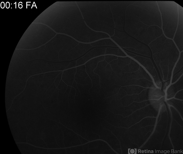 Proliferative Diabetic Retinopathy With Vitreous Hemorrhage - Fa Early 