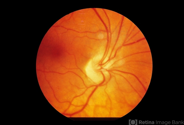 Disc Situs Inversus - Retina Image Bank
