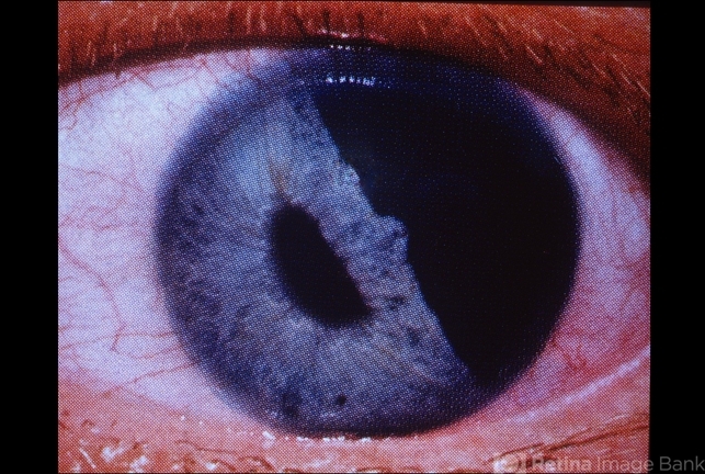 Traumatic Iridodialysis - Retina Image Bank