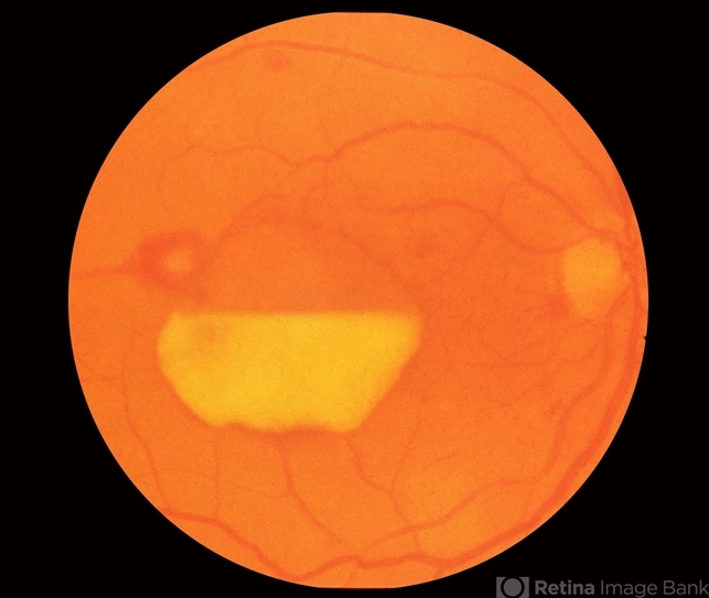 Donut-Shaped Subhyaloidal Hemorrhage - Retina Today