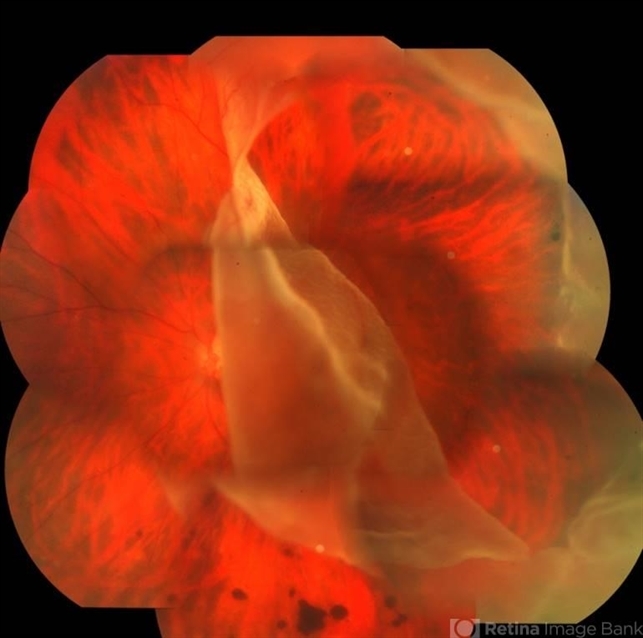 Giant Retinal Tear - Retina Image Bank