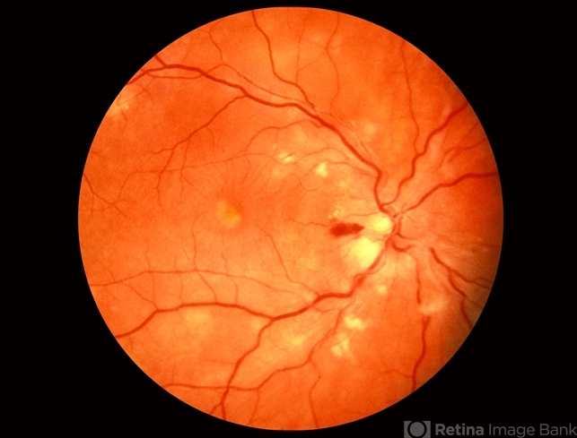 Malignant hypertension online