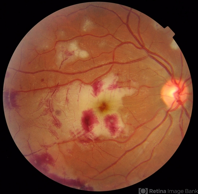 Retinal Vasculitis Retinal Inflammatory Disease My Xxx Hot Girl