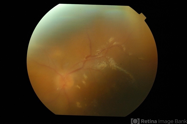 Post Injection Candida Endophthalmitis - Retina Image Bank