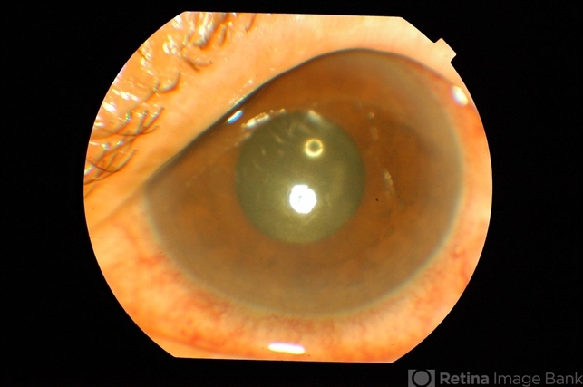 Post Injection Candida Endophthalmitis - Retina Image Bank