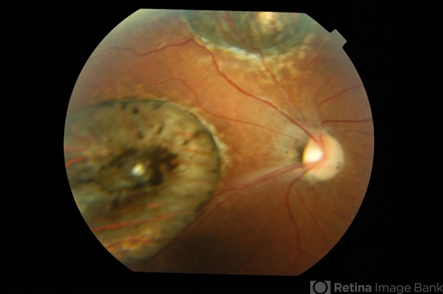 Macular Coloboma - Retina Image Bank