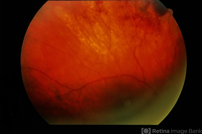 Eales Disease - Retina Image Bank