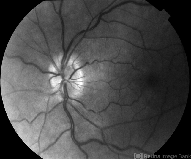 Myotonic Dystrophy Maculopathy - Retina Image Bank