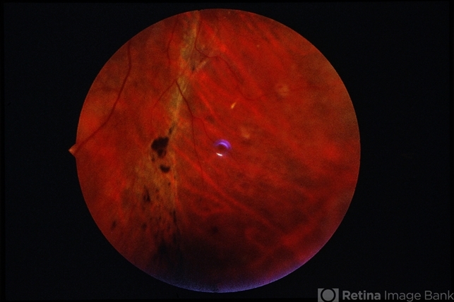 Angioma from Chronic Retinal Detachment - Retina Image Bank