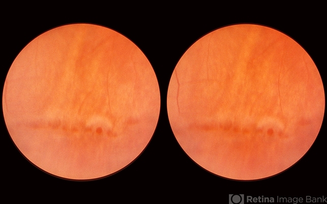 Lattice Lesion Retina Image Bank