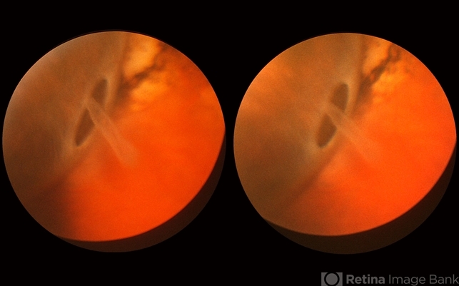 Retinal Break at Site of Lattice Degeneration with Scleral Indentation ...