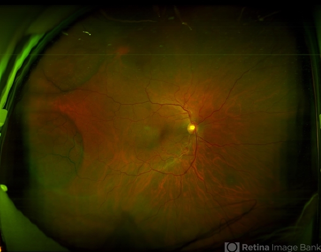 Retinoschisis Right Eye - Retina Image Bank