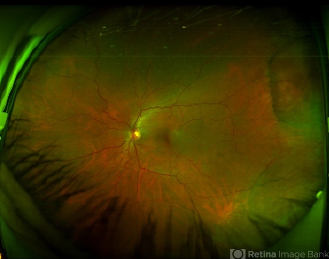 Retinoschisis Left Eye - Retina Image Bank