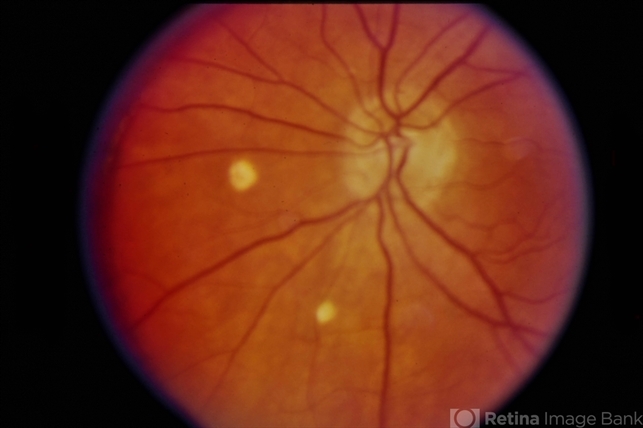 Presumed Ocular Histoplasmosis Syndrome Retina Image Bank