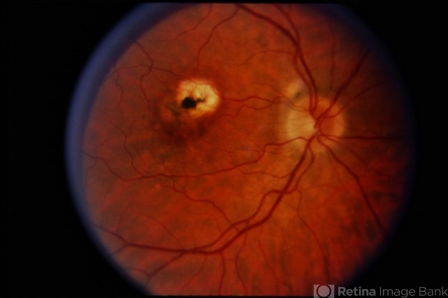 Presumed Ocular Histoplasmosis Syndrome Retina Image Bank