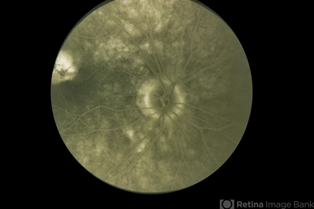 Presumed Ocular Histoplasmosis Syndrome Retina Image Bank