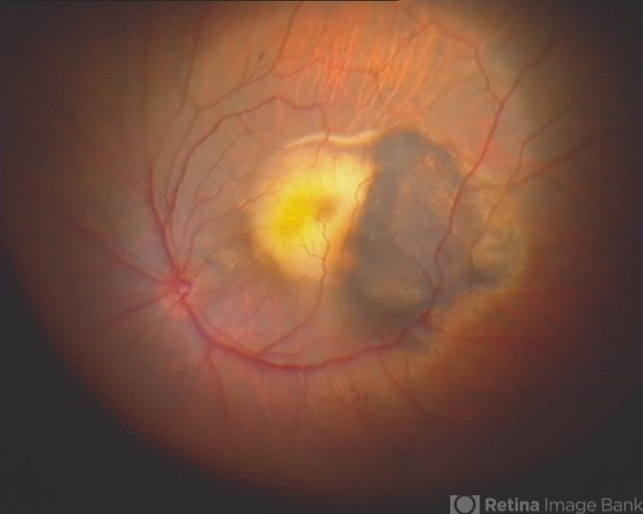Bleeding Macula Chronical Submacular Hemorrhage in the Setting of Neovascular AMD ...