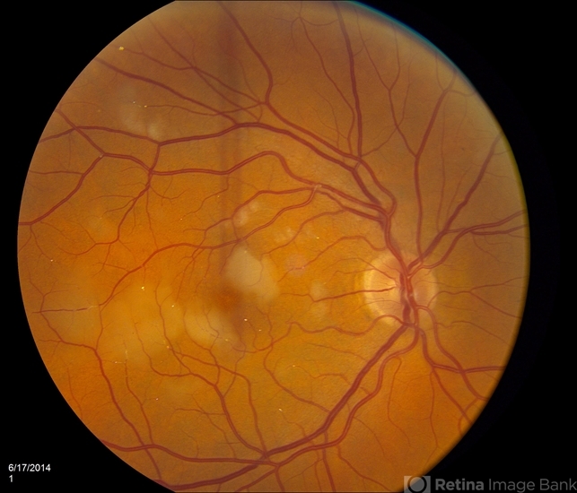 Multiple Acute Embolic Branch Retinal Artery Occlusions - Retina Image Bank