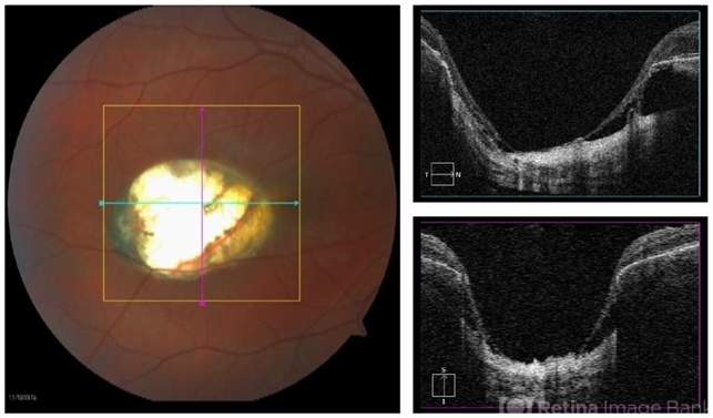 Ocular Toxoplasmosis Retina Image Bank 8377