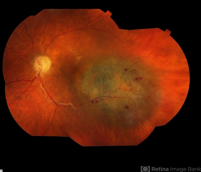 Malignant Choroidal Melanoma - Retina Image Bank