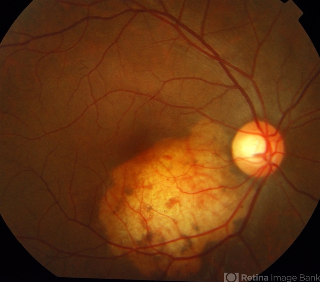 Choroidal Osteoma - Retina Image Bank