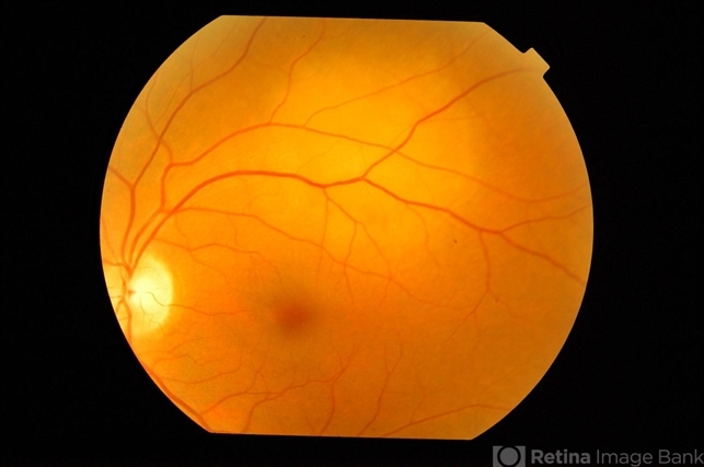 Choroidal Metastasis From Pulmonary Adeno Carcinima - Retina Image Bank